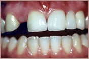 smile with missing tooth