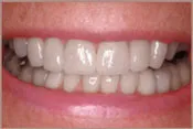 smile with white teeth