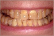 smile with yellow teeth