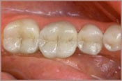 teeth with tooth colored fillings