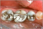 teeth with silver fillings
