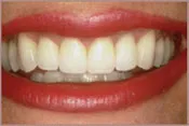 smile with white teeth