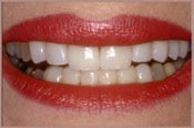 smile with white teeth